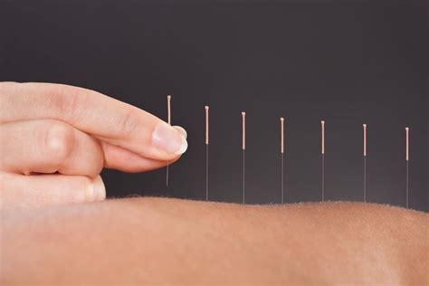 needle acupuncture near me.